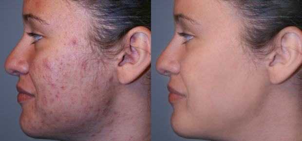 Microdermabrasion for Acne Scars: What to Expect