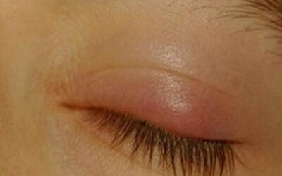 Everything about Eyelid Bumps
