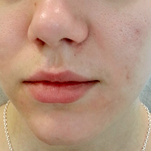 acne removal
