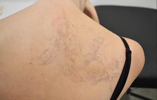How to Treat or Remove Tattoo Scars
