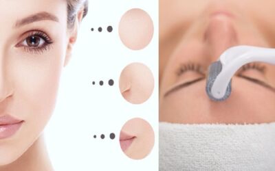 Complete Guide to Do Mesotherapy At Home