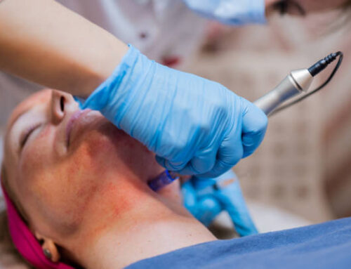 Microneedling: The Facts About this Buzzworthy Skin Procedure