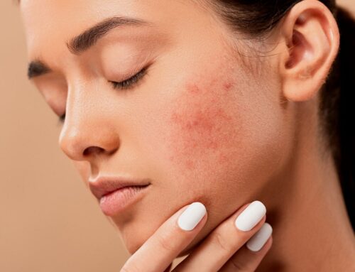 Stress Acne: What Causes It and How It Differs From Other Acne
