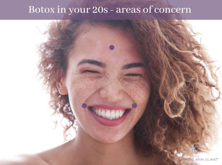 botox in 20s