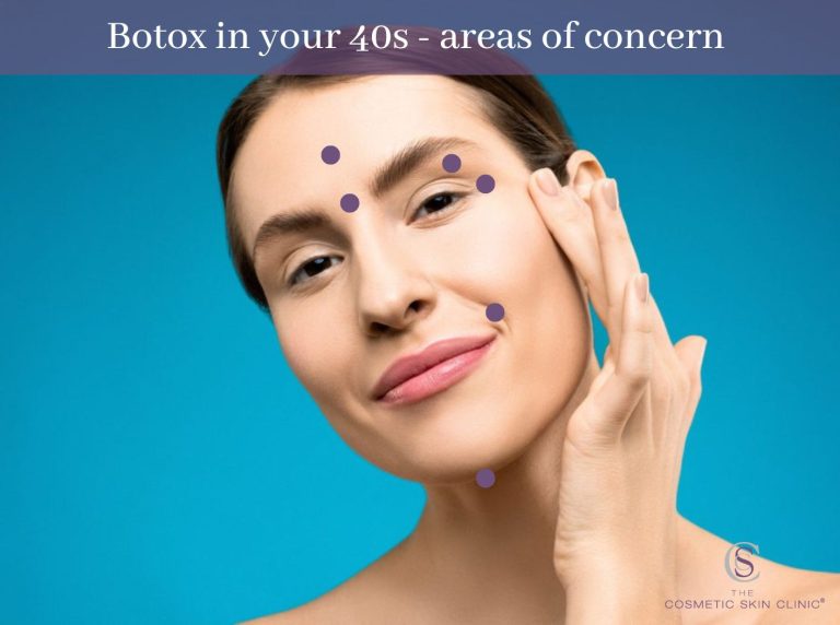 botox in 40s