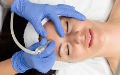 Microdermabrasion for Acne Scars: What to Expect