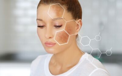 What Is Hyperpigmentation?