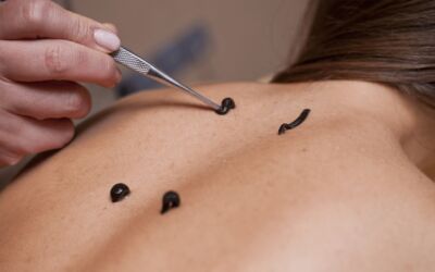What Is Leech Therapy?