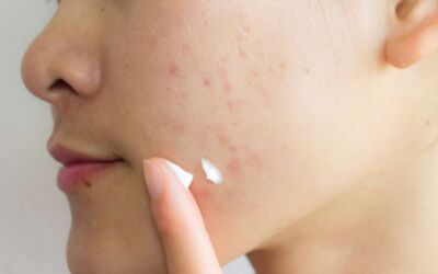 Acne Scars: Types and Removals