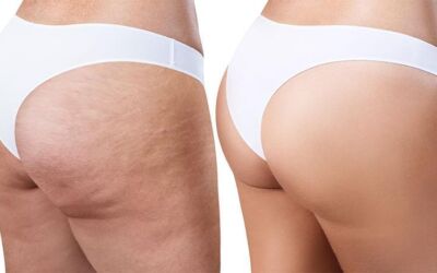 Cellulite : Everything you need to know