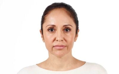 Juvederm vs. Restylane: Comparing the Dermal Fillers
