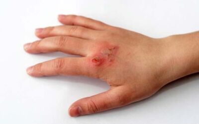 Best Home Remedies For Burns