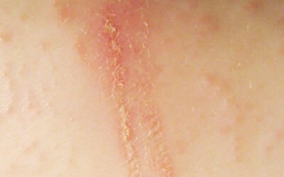 Scabs and Sores on Scalp