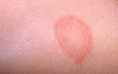 Dry skin patches: Causes, symptoms