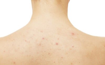 Back acne: How to get rid of it