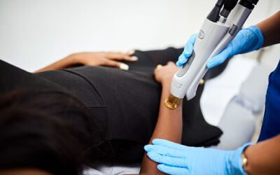 Laser Hair Removal for Black Skin