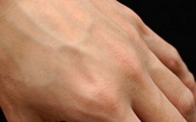Causes of and Treatments for Thin Skin