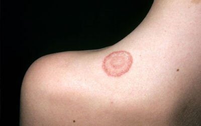 Ringworm: Treatment, Pictures, Causes, and Symptoms