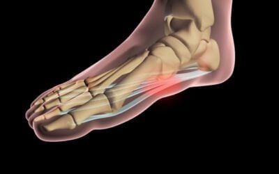 Causes of Heel Pain After Running