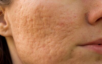 Pockmarks: Definition, causes, and treatment