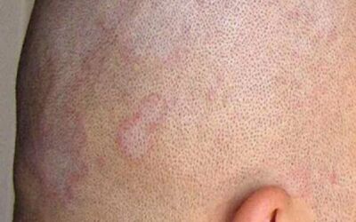 What is seborrheic dermatitis?