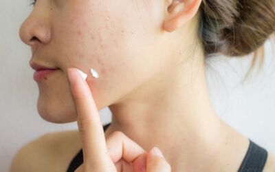 How to get rid of acne scars: Treatments and home remedies