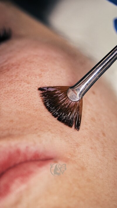 Chemical peel Home page Serivce Image Chemical Peel