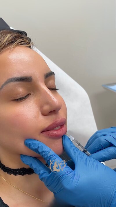 Lip Filler Home page Serivce Image Injectable Cheek Fillers Ajax