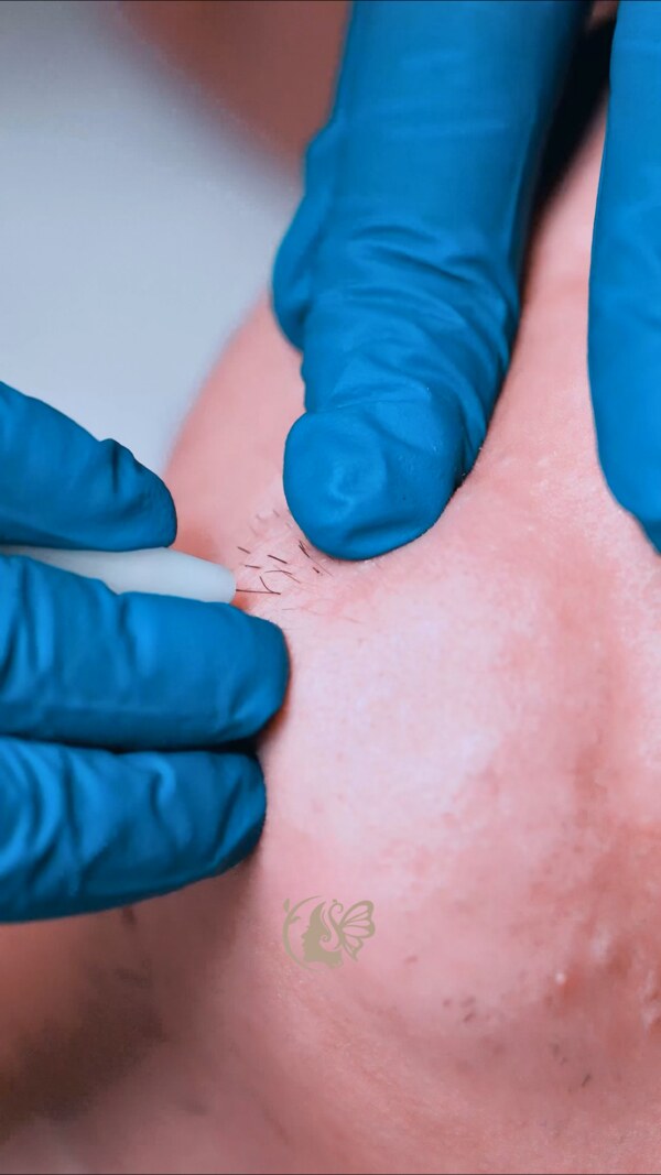 Elecrolysis service image