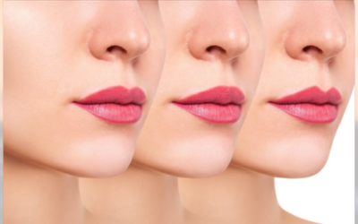 Benefits of Lip Filler Treatment: Key Advantages Explained