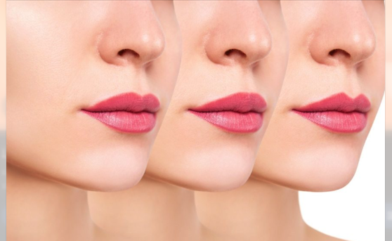 Lip Filler Treatment