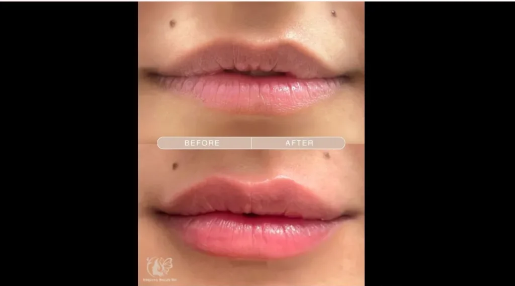 Before and after lip filler in Ajax results showing fuller, more hydrated lips at Elegancy Beauty Bar