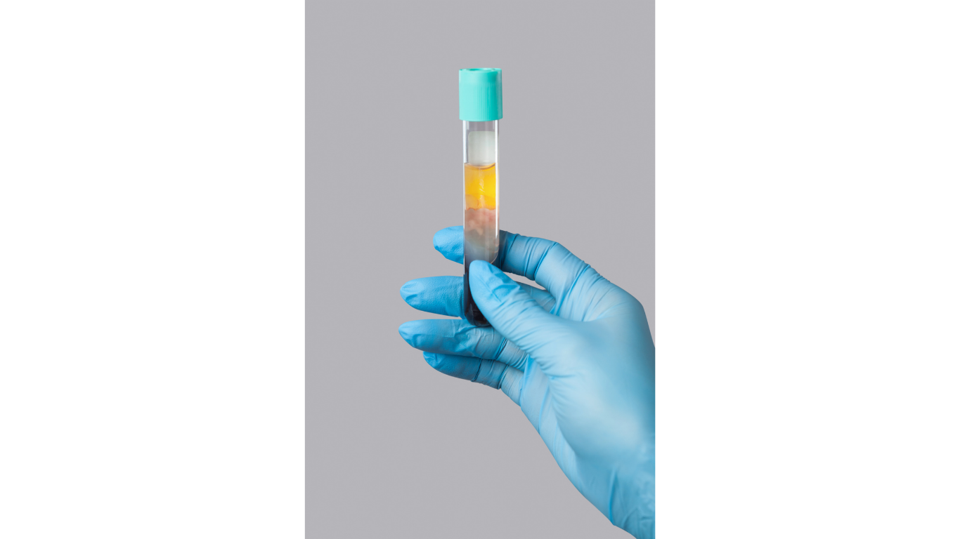 PRP Microneedling