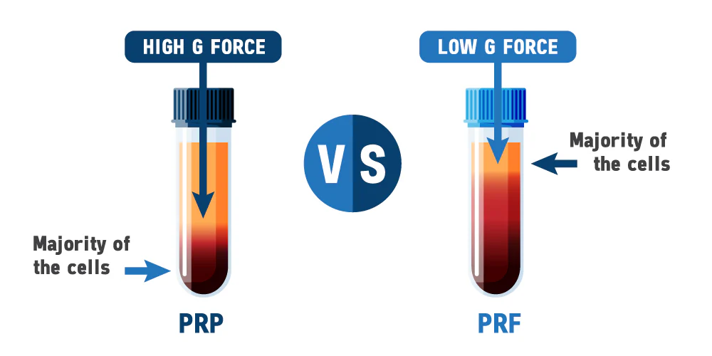 PRP_vs_PRF