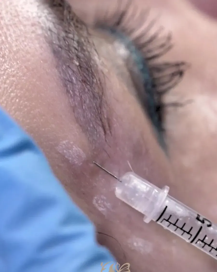 Botox injection at Elegancy Beauty Bar in Ajax