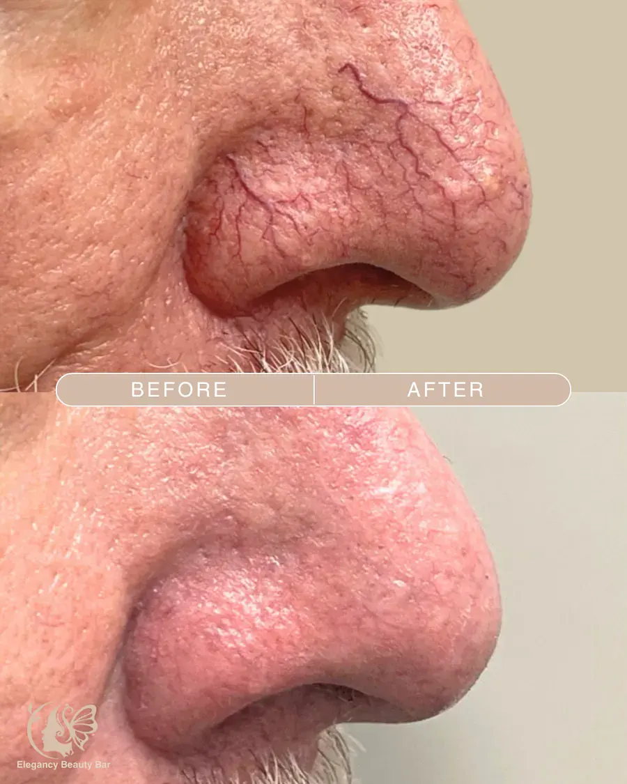Laser vein removal on the nose, before and after, at Elegancy Beauty Bar