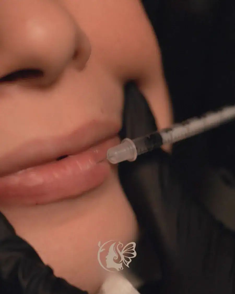 Lip filler injection at Elegancy Beauty Bar in Ajax