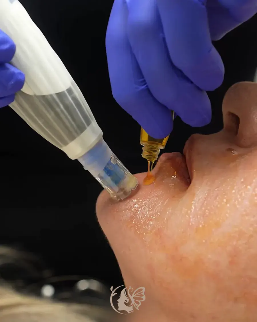 Meso-Glide microneedling with a DP4 pen at Elegancy Beauty Bar in Ajax
