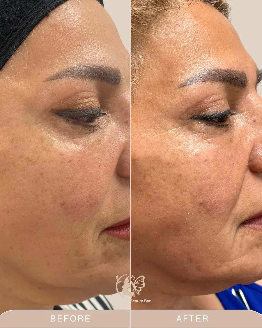 Skin tightening before and after at Elegancy Beauty Bar